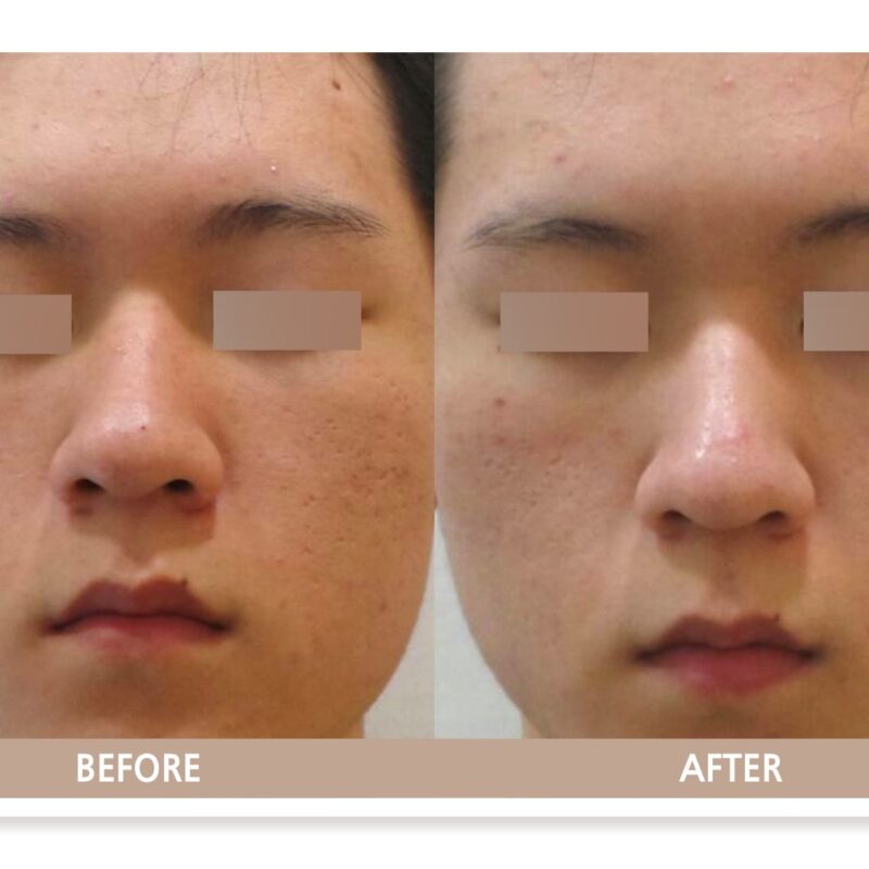 일산 여드름 흉터 및 모공 치료 전후사진 정면 비교