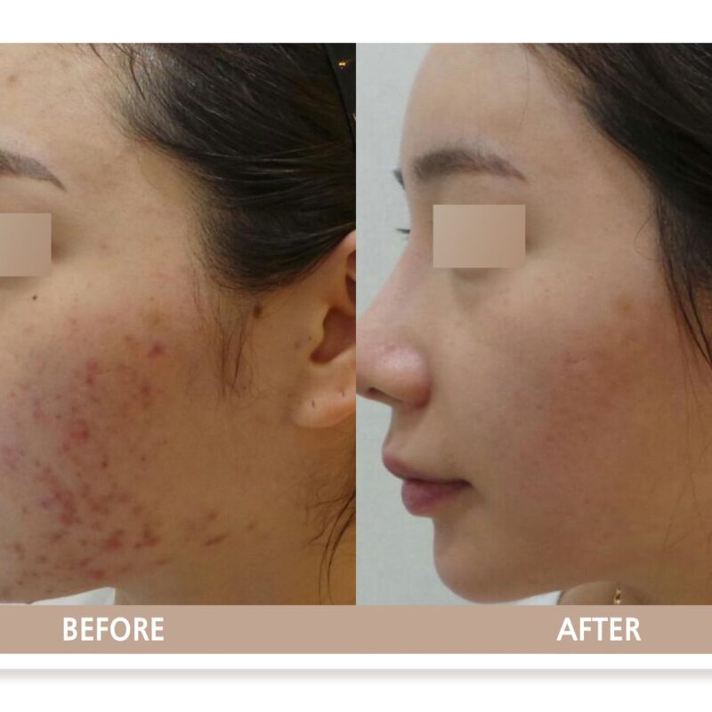 일산 여드름 치료 전후 피부 개선 사례