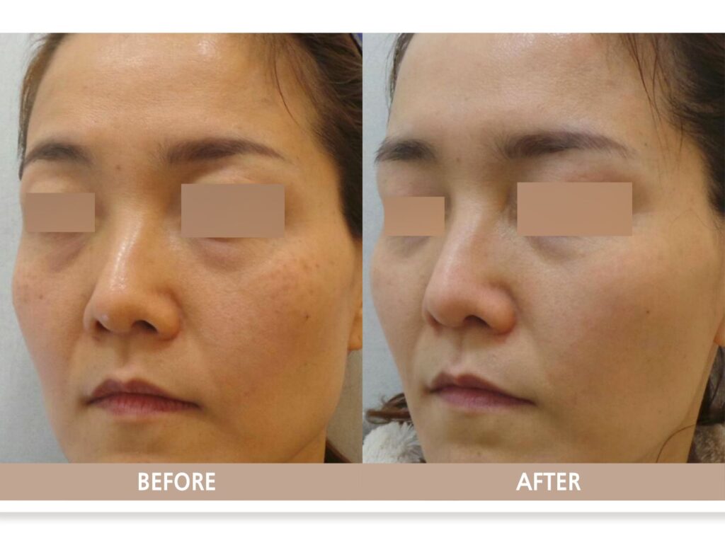 일산 후천성 오타모반 치료 전후사진 정면 비교