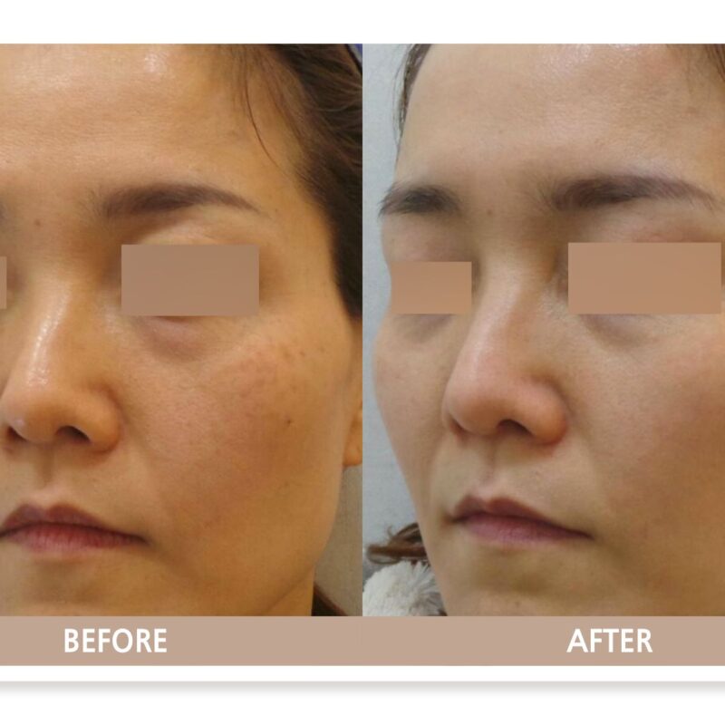 일산 후천성 오타모반 치료 전후사진 정면 비교