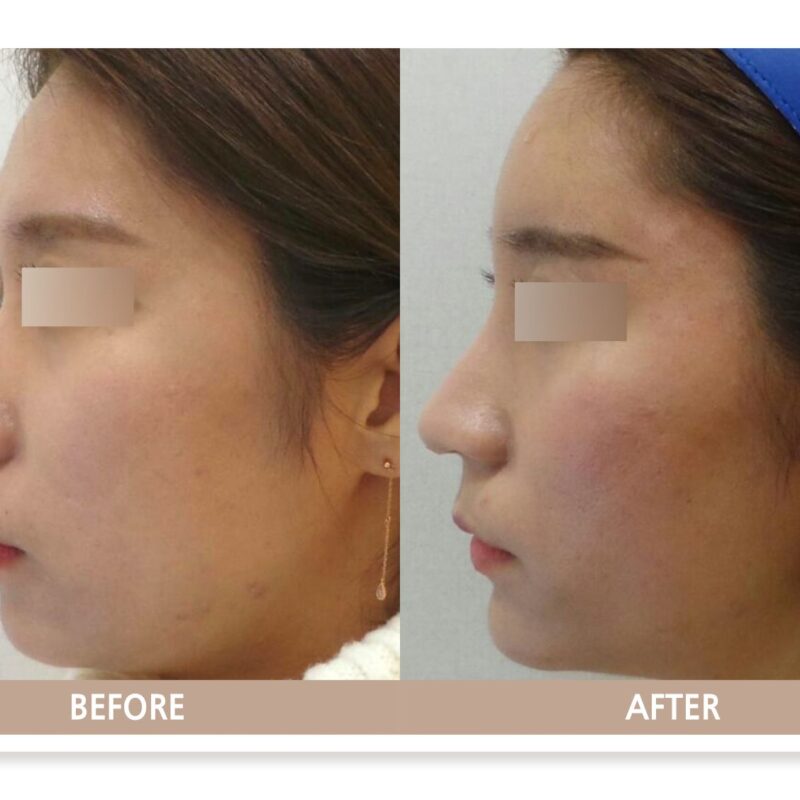 일산 이마 필러 시술 전후사진 측면 비교