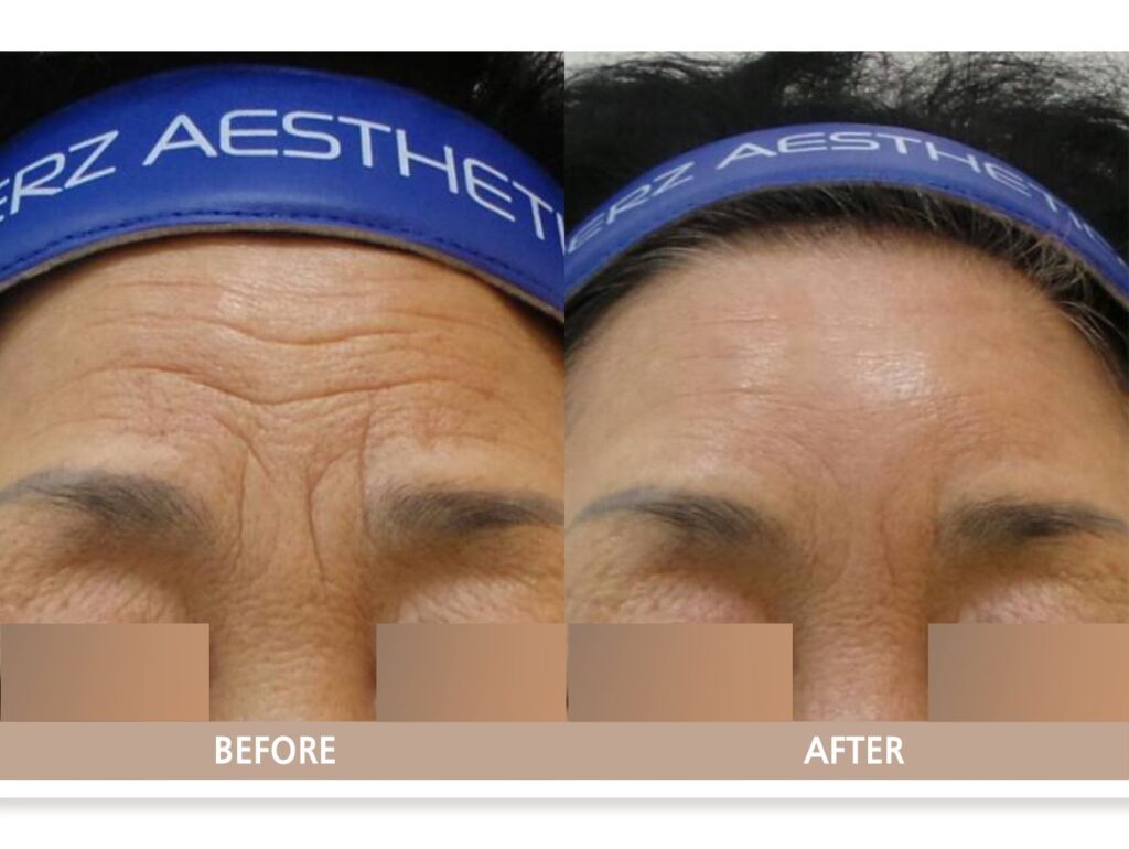 일산 이마 주름 필러 시술 전후사진 정면 비교