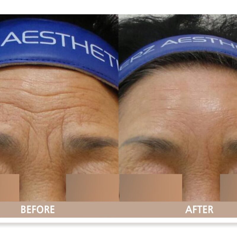 일산 이마 주름 필러 시술 전후사진 정면 비교