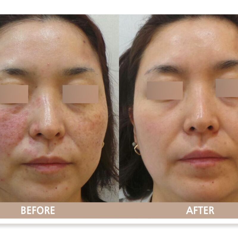 일산 흑자증 치료 전후사진 정면 비교