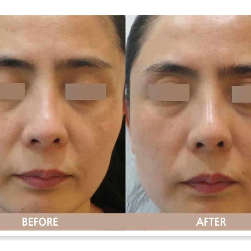 일산 리뉴앤영 의원에서 기미 치료 전후 피부 변화