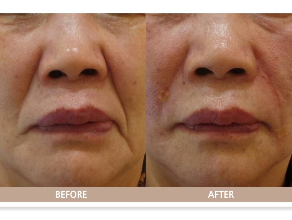 일산 리뉴앤영 의원에서 팔자 주름 필러 및 실리프팅 시술 전후 얼굴 변화