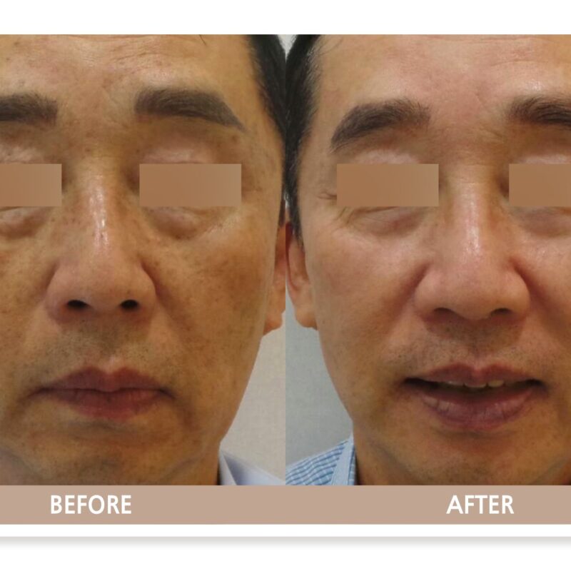 일산 리뉴앤영 의원에서 검버섯(흑자, 지루각화증) 레이저 치료 전후 피부 변화