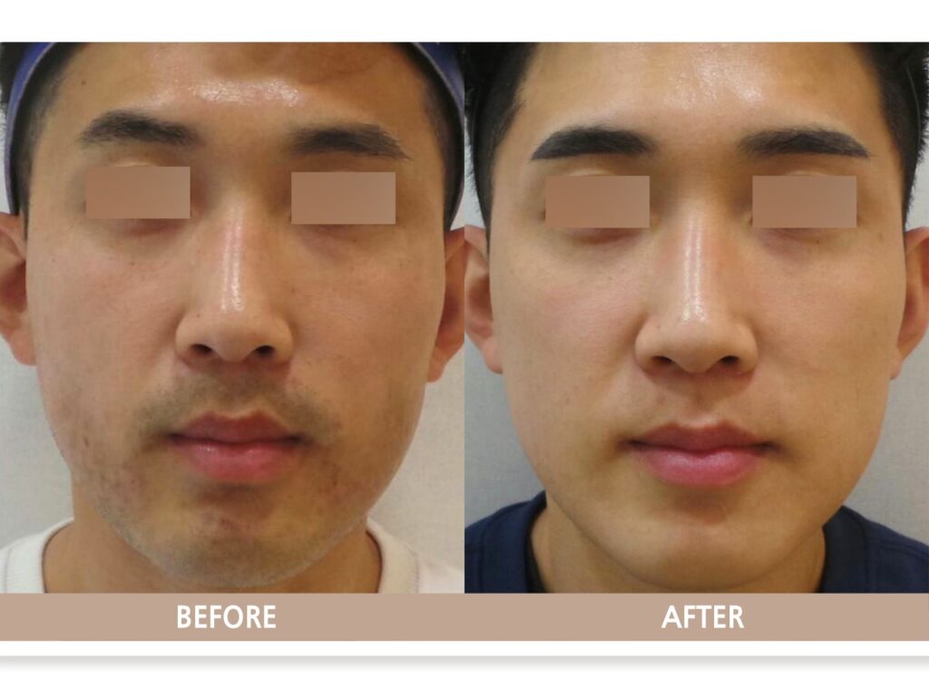 일산 리뉴앤영 의원에서 색소침착 치료 전후사진 피부 변화