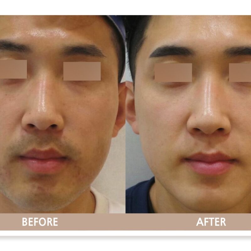 일산 리뉴앤영 의원에서 색소침착 치료 전후사진 피부 변화