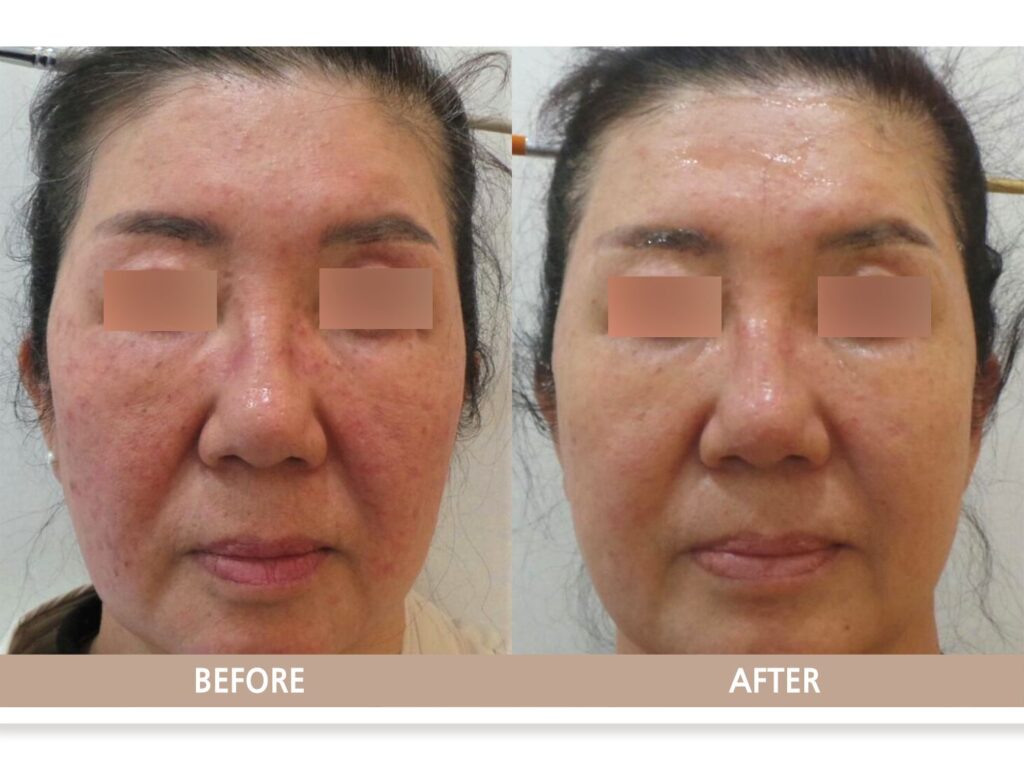 고양시 일산 리뉴앤영 의원 주사 피부염 및 홍조 레이저 치료 전후사진(정면)