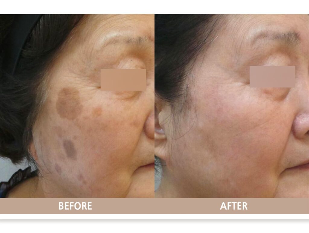 일산 리뉴앤영 의원에서 검버섯 (흑자) 레이저 치료 전후 피부 변화