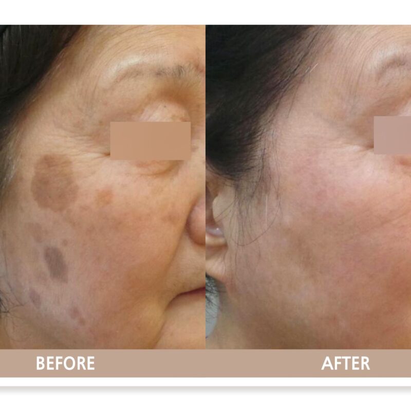 일산 리뉴앤영 의원에서 검버섯 (흑자) 레이저 치료 전후 피부 변화