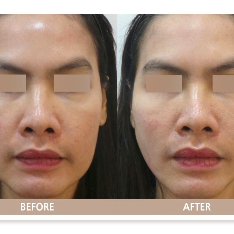 일산 실리프팅 전후사진, PDO 코그실을 이용해 처진 볼 아래 살을 끌어올려 옆볼 꺼짐이 개선된 사례.