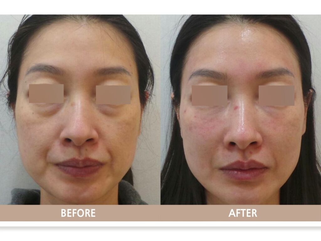 일산 눈밑필러 전후사진, 다크서클과 눈밑 꺼짐을 소량 필러로 자연스럽게 개선한 사례