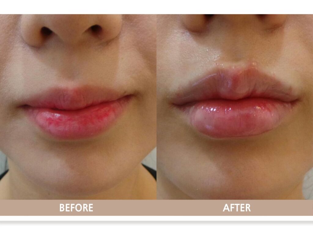 자연스러운 볼륨과 입꼬리 개선이 확인되는 입술필러 전후사진