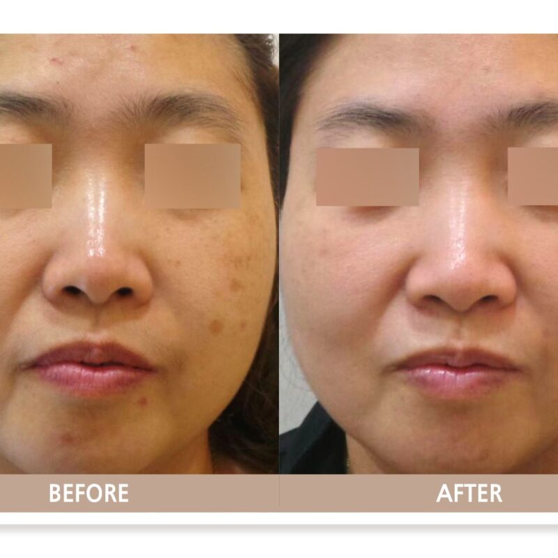 기미, 검버섯(일광 흑자) 복합 병변의 케이스, 기미 악화 없이 검버섯(일광 흑자)만 깔끔하게 제거됨.