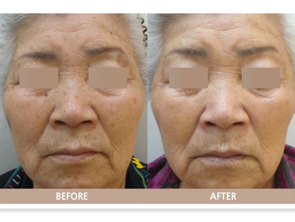 80대 노인성 흑자 전후사진, 얼굴 검버섯이 755nm 피코 레이저 치료 후 옅어진 모습