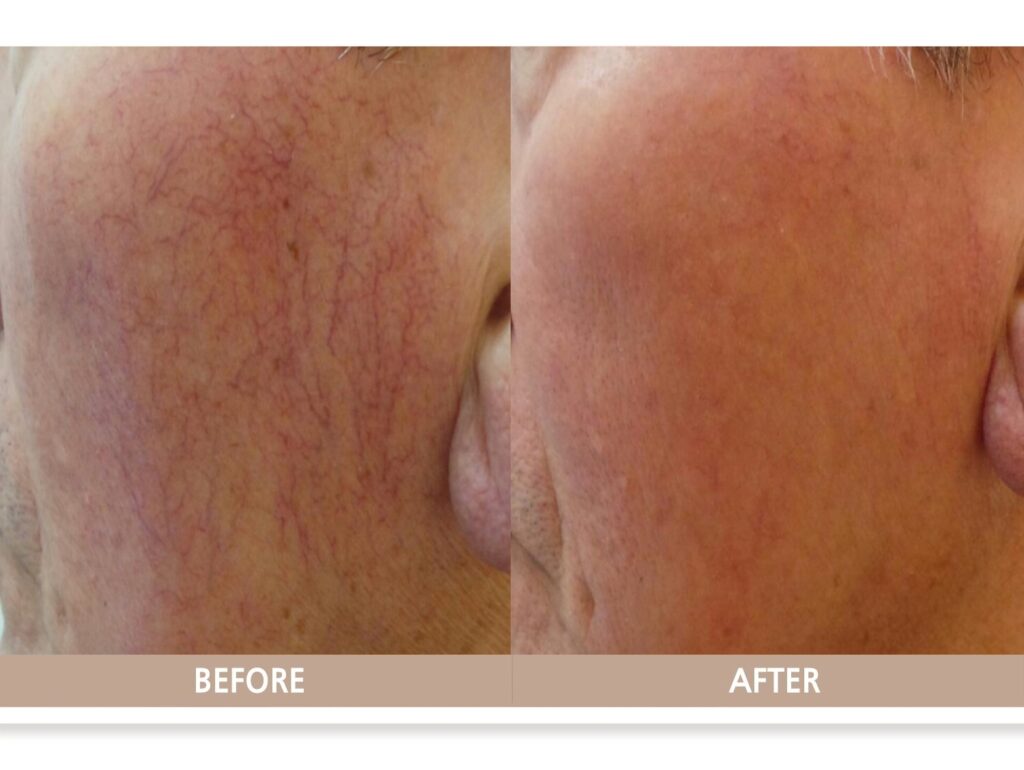 고양시 일산 얼굴 모세혈관 확장증 전후사진 – 붉은 혈관이 정리된 안면 치료 결과