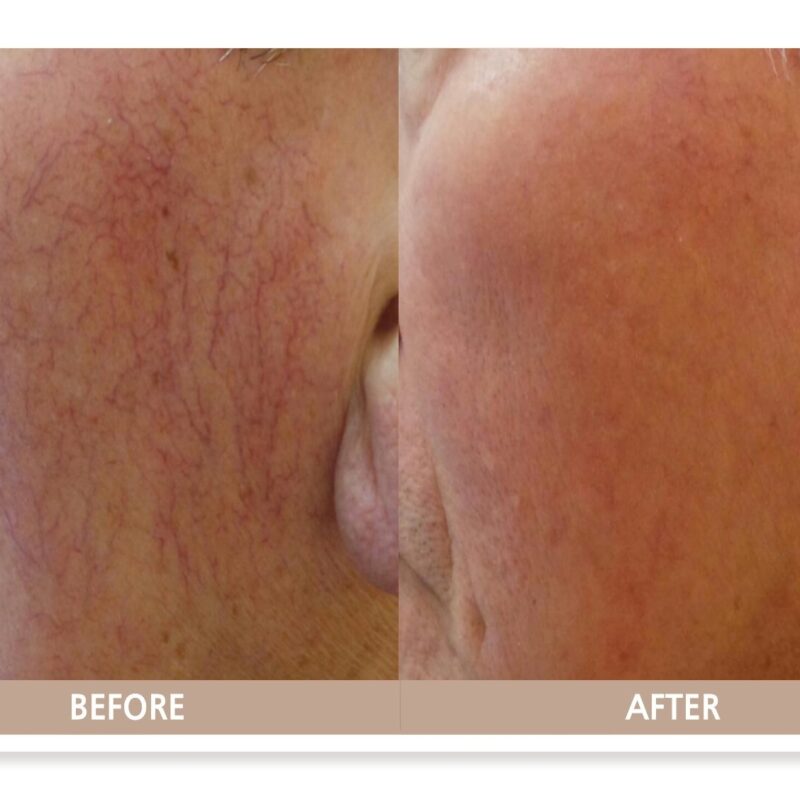 고양시 일산 얼굴 모세혈관 확장증 전후사진 – 붉은 혈관이 정리된 안면 치료 결과