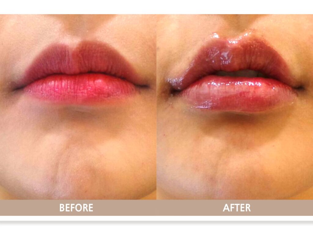 일산 입술필러 전후사진 정면 비교, 자연스러운 입술 볼륨 변화