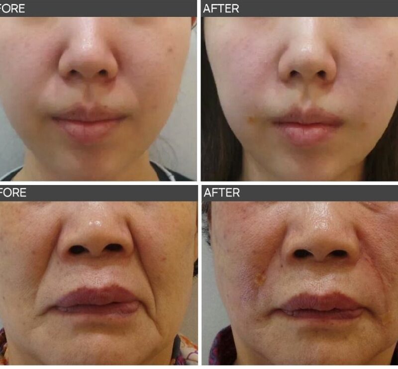 일산 리뉴앤영의 정면과 측면 비교로 본 팔자주름 필러 전후사진, 과하지 않게 인상이 자연스럽게 정돈된 케이스