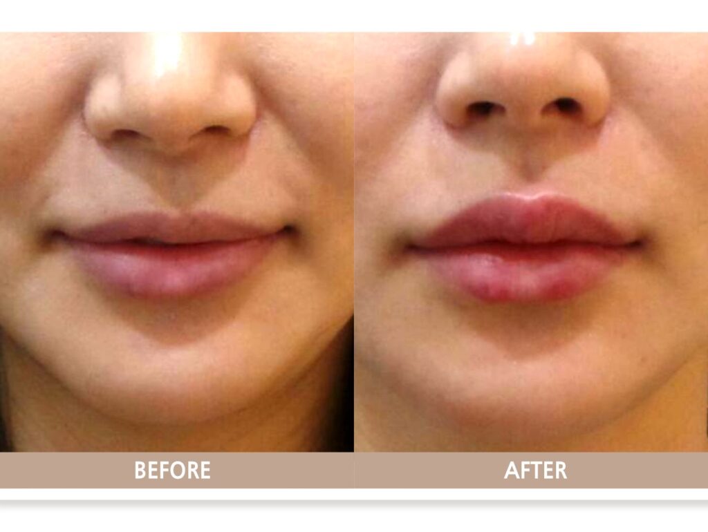 일산 입술 필러 전후사진, 입술 볼륨과 비율이 자연스럽게 개선된 모습
