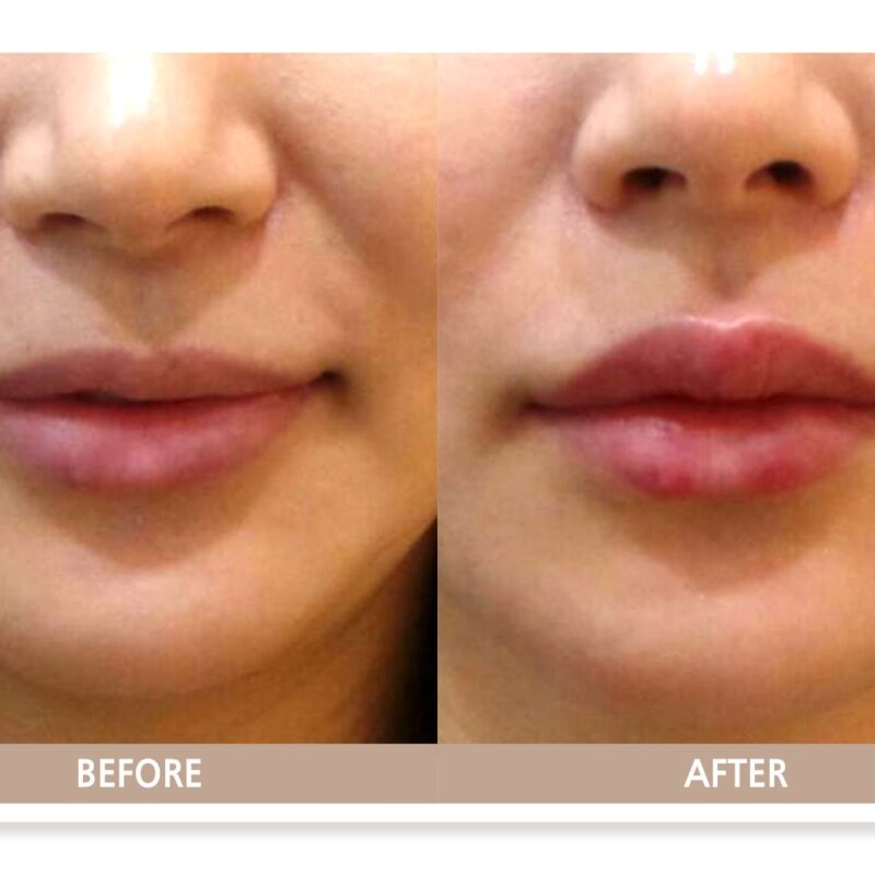 일산 입술 필러 전후사진, 입술 볼륨과 비율이 자연스럽게 개선된 모습