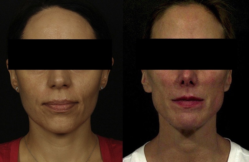 울쎄라 후 볼 꺼짐이 의심되는 얼굴 변화 사례 정면 비교 사진