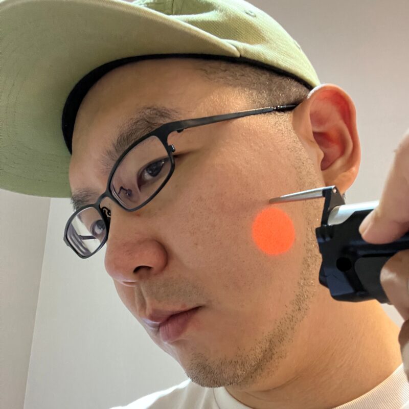 일산 리뉴앤영 의원 대표원장이 아포지 엘리트플러스로 직접 레이저제모 시술하는 모습