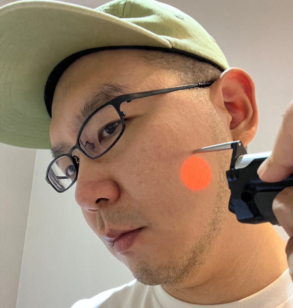 일산 리뉴앤영 의원 대표원장이 아포지 엘리트플러스로 직접 레이저제모 시술하는 모습