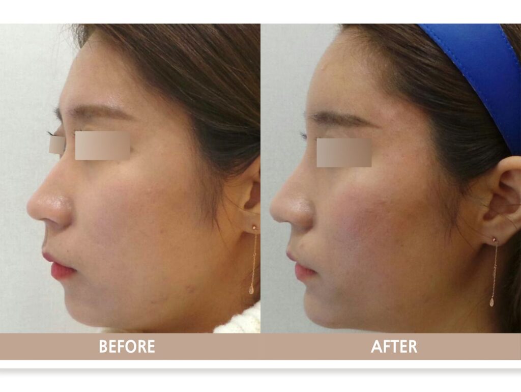 일산 필러 시술 전후의 이마 꺼짐과 옆선 변화를 비교한 사진