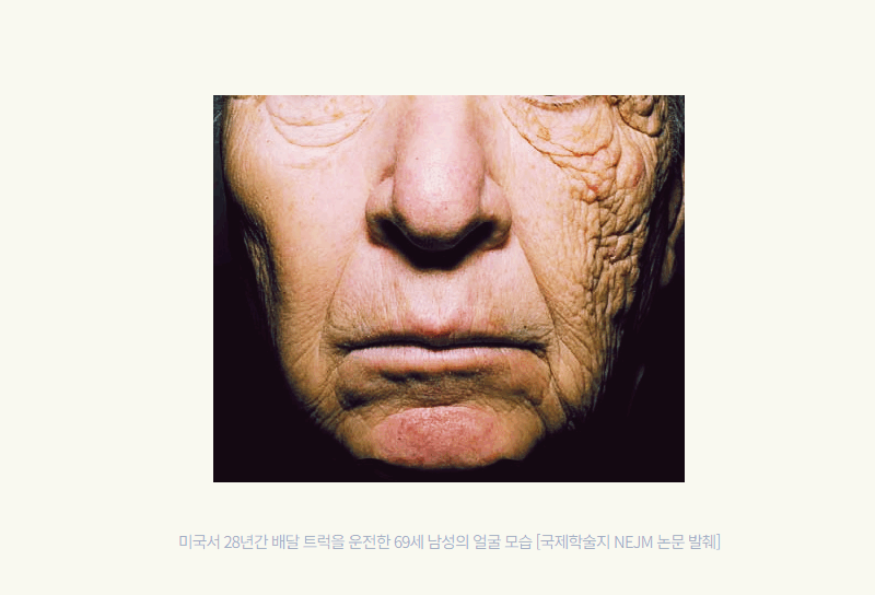 자외선에 오래 노출된 피부와 자외선을 차단한 피부의 노화 정도를 비교한 개념 이미지