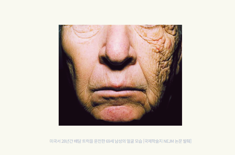 자외선에 오래 노출된 피부와 자외선을 차단한 피부의 노화 정도를 비교한 개념 이미지