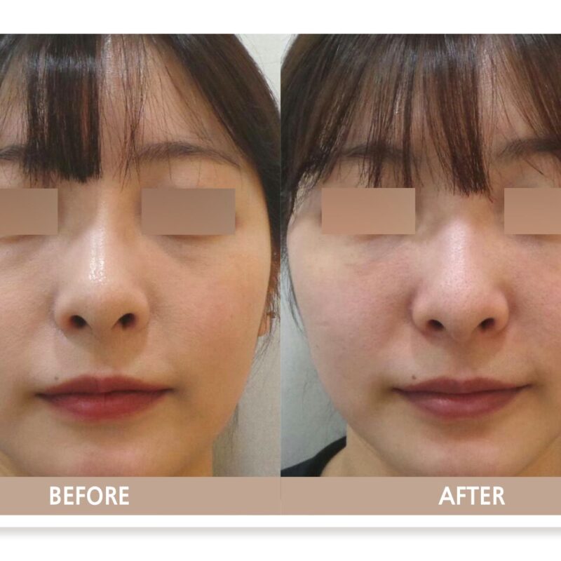 젊은 환자의 눈밑 꺼짐과 다크서클 음영을 비교한 눈밑 필러 정면 전후사진