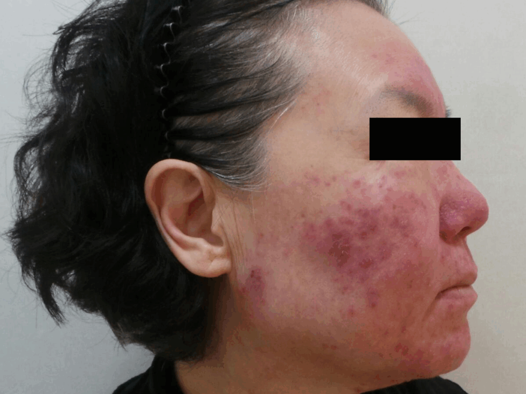 얼굴 홍조 치료 전 양 볼과 코 주변에 넓은 붉은기와 확장된 혈관이 나타난 피부 상태를 보여주는 측면 사진