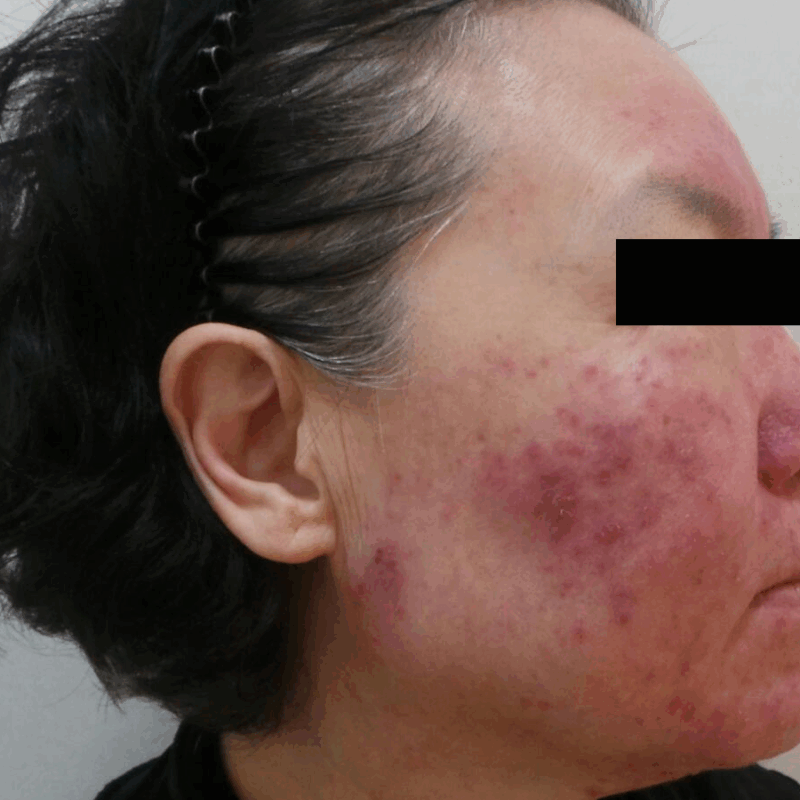얼굴 홍조 치료 전 양 볼과 코 주변에 넓은 붉은기와 확장된 혈관이 나타난 피부 상태를 보여주는 측면 사진